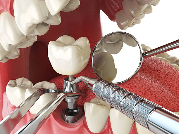 Best Emergency Gum Treatment in Fountain Valley, CA